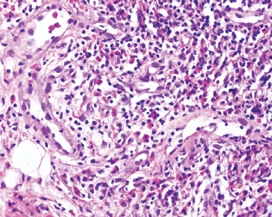 Core biopsy showing fibroadipose tissue with lobules of inflammatory cells, i.e. lymphocytes, eosinophils and interspersed small vascular channels lined by plump endothelial cells, suggestive of angiolymphoid hyperplasia with eosinophilia (H and E, ×40).